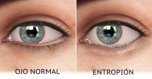 Image result for Entropion