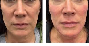 When we age the face sinks and shrinks and not all at the same time. Facial  balancing is almost always a MUST when dermal filler and facial  rejuvenation are discussed. Many patients