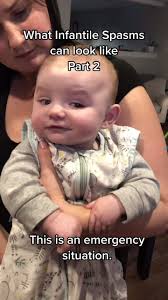 Image result for Infantile Spasms