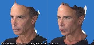 Catwoman's fiancé Lloyd Klein unveils his new face after rejuvenation  procedure