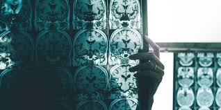 The drug aducanumab has been approved in the us. Biogen Alzheimer S Drug Aducanumab Fda Filing Update What We Know