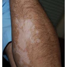 Possible risks include infection, scarring, a cobblestone appearance, spotty color and failure of the area to recolor. Vitiligo Patches On Left Arm Distant From The Location Of Dpcp Application Download Scientific Diagram