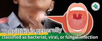 Image result for Tonsillitis