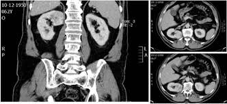 Here we reveal the 12 main symptoms of kidney cancer: Synchronous Bilateral Renal Cell Carcinoma And Prostate Cancer A Bad Luck Case With A Good Outcome