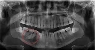 Homem Descobre Que Dor Na Boca Nao Era Dente Mas Pedra Na Glandula Salivar 05 03 2020 Uol Vivabem