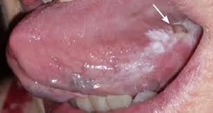 Image result for white cancer on tongue)