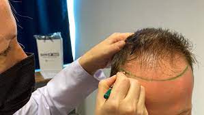 Check spelling or type a new query. Was Kann Bei Einer Haartransplantation Alles Schief Laufen Profile Birdwatchers Forum
