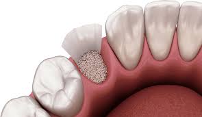 Image result for Tooth Extraction