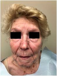 An atypical presentation of extensive centrofacial microcystic adnexal  carcinoma responding to radiation: A case report and review of the  literature