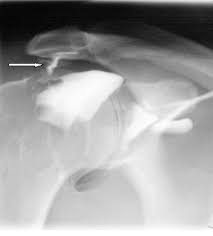 Tendons in the rotator cuff can be injured easily because they move within a tight space. Shoulders Brace Am Sob 05 Reh4mat Lower Limb Orthosis And Braces Manufacturer Of Modern Orthopaedic Devices