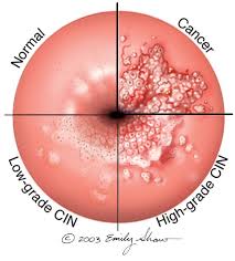 Pin On Hpv Cervical Cancer