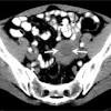 In other cases, the contrast agent is injected. 1