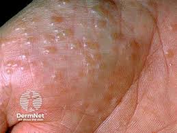 Image result for scabies symptoms