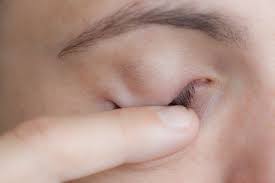 Eye Exercises To Decrease Ptosis Eye Exercises Lazy Eye Exercises Face Yoga