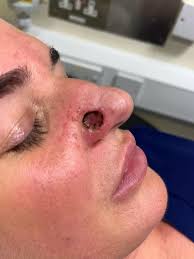 Image result for skin cancer on nose pimple