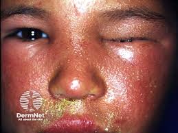 Image result for Rhus Dermatitis