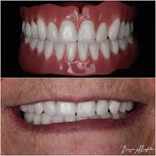 Image result for dentures