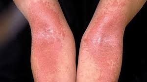Egzama Icin Evde 10 Dogal Tedavi Tavsiyesi Sekerkadin Psoriasis Pictures Eczema Pictures Baby Eczema