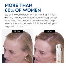 This type of hair loss occurs (in both men and women) when the. Anti Hair Loss Products Hair Growth Spray Essential Oil Liquid For Men Women Hair Growth Essence Serum Hair Care Repair Growing Hair Loss Products Aliexpress