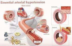 Pin On Blood Pressure Remedies