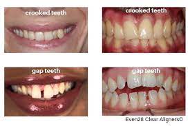 How long do braces take to straighten out your teeth? Even28 At Home Clear Aligners Even28 Dentist Search Engine