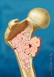 Image result for Chondrosarcoma