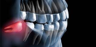 Weisheitszahn Op Die Zeit Danach Zwp Online Das Nachrichtenportal Fur Die Dentalbranche