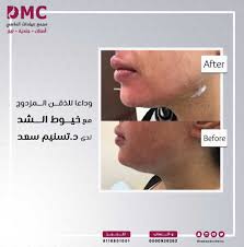 وداعا للذقن المزدوج مع خيوط الشد التجميلية علاج وشد الذقن المزدوج بالخيوط Omc Incoming Call Screenshot Movie Posters