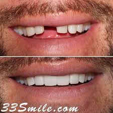 This Patient Was So Happy With His Result We Provide Permanent Solutions For Missing Teeth San Antonio Tx Dental Cosmetics Dental Practice Dental Procedures