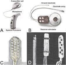 That's when it's time to consider cochlear implants, a medical device technology that thousands of people around the world rely on, as a way to restore hearing. Frontiers Auditory Brainstem Implants Recent Progress And Future Perspectives Neuroscience