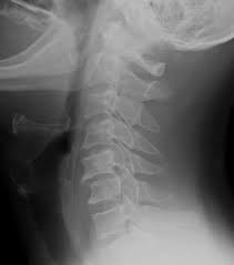 Joint mobilisation techniques can be used to unlock the facet joints, . Locked Facet Joint Radiology Reference Article Radiopaedia Org
