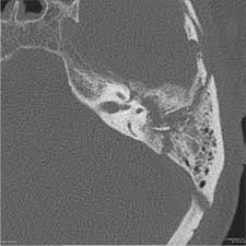 Image result for Ossicular Chain Disruption