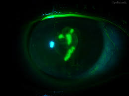 Human tear fluid protects against pseudomonas aeruginosa keratitis in a murine experimental model / mary s. Herpes Simplex Keratitis