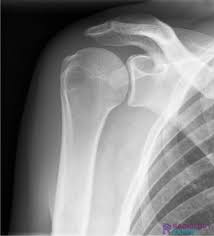 Image result for Shoulder XRay