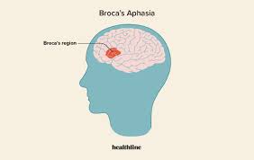Image result for Aphasia