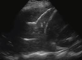 Image result for Air Bronchogram