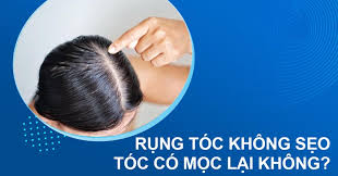 Rụng tóc không sẹo có bao nhiêu loại? Có thể mọc lại không?