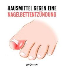 Die 40 Besten Ideen Zu Zehennagel Eingewachsen Zehennagel Eingewachsene Zehennagel Eingewachsener Zehennagel