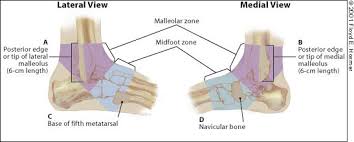 If there is pain somethings wrong.does not always present with swelling or bruising unless there is direct trauma.tendonitis is the correct term. Management Of Ankle Sprains American Family Physician