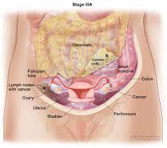 The ovaries are organs about the size and shape of unshelled almonds, located on either side of and somewhat behind the uterus. Ovarian Fallopian Tube Cancers Hematology Oncology Associates Of Cny