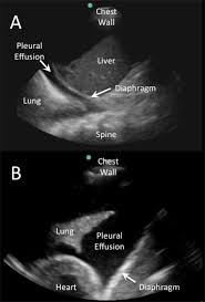 Major lung ultrasound pathology profiles. Ultrasound In The Diagnosis And Management Of Pleural Effusions Abstract Europe Pmc