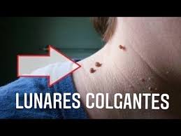 Como Quitar Lunares De Carne Youtube