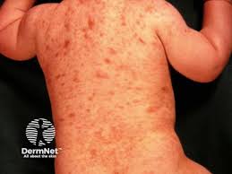 Image result for Urticaria pigmentosa children
