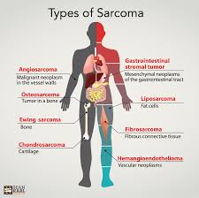 Sarcoma Types Png 1267 1265 Sarcoma Oncology Nursing Malignant Neoplasms