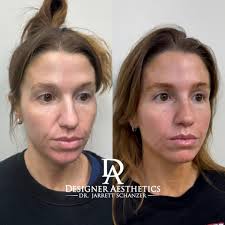 Smile Lines & Nasolabial Fold Fillers