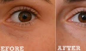 Natural Remedy For Sagging Eyelids You Will See Results In 2 Minutes Just Natural Me Bumps Under Eyes Skin Tag On Eyelid Skin Care Treatments