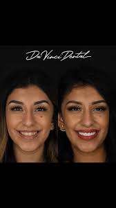 It’s a common belief that in order to have, Veneers placed, real teeth need  to be drilled down to stumps! We have found the excessive drilling is  unnecessary and removal of too much healthy enamel is ...