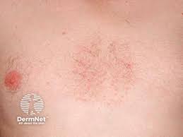 Image result for Seborrheic Dermatitis
