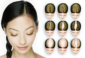 Doctors refer to the ludwig classification for. Minoxidil For Women Review Wikipedia