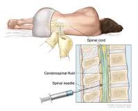 Image result for what is serum treatment for pneumonia